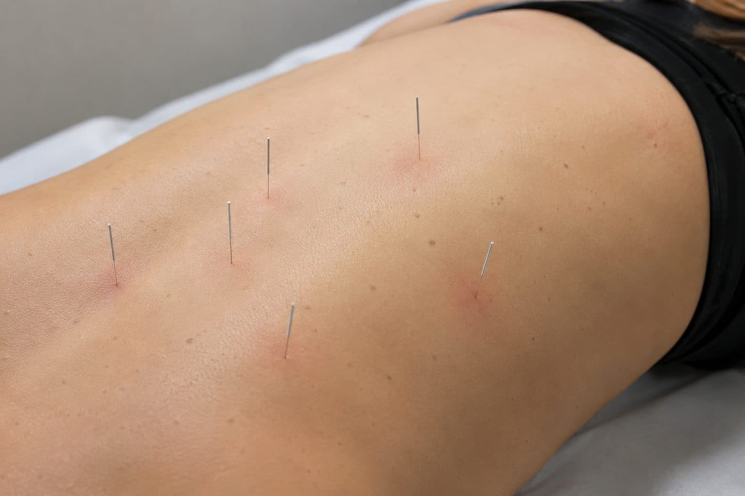 Dry Needling vs Acupuncture: What's the Difference?